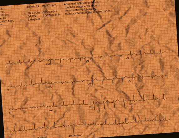 Normal ECG — PTB-XL