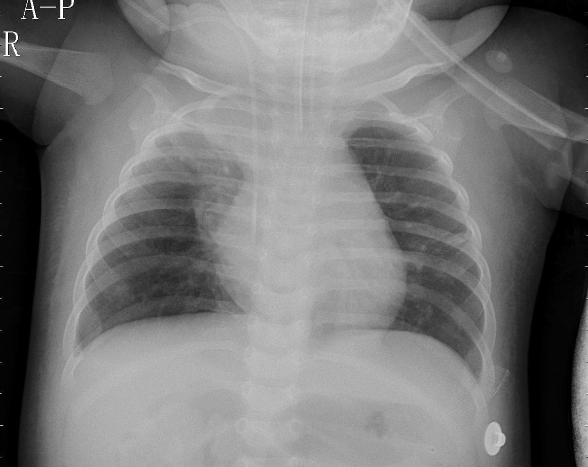 Pneumonia — NIH Chest X-ray14