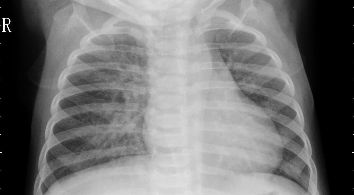 Pneumonia — NIH Chest X-ray14