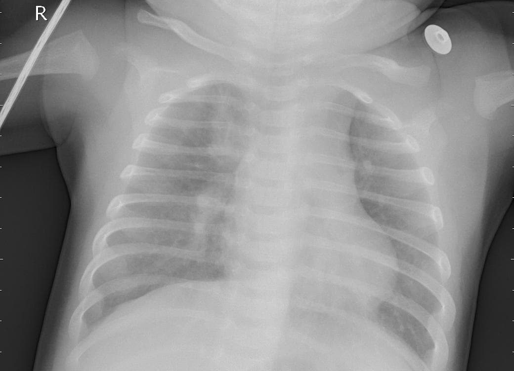 Pneumonia — NIH Chest X-ray14