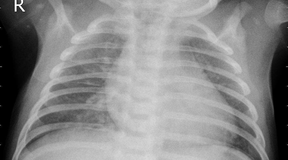 Pneumonia — NIH Chest X-ray14