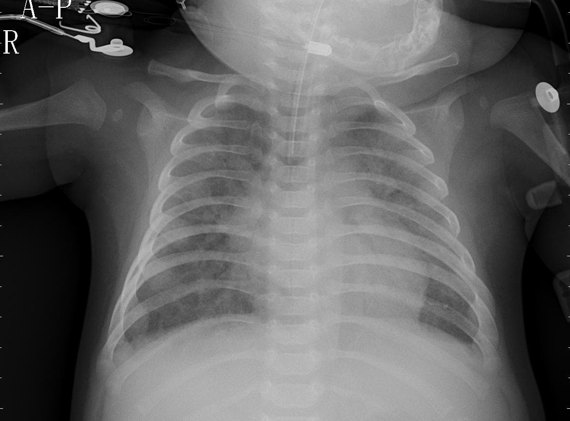 Pneumonia — NIH Chest X-ray14