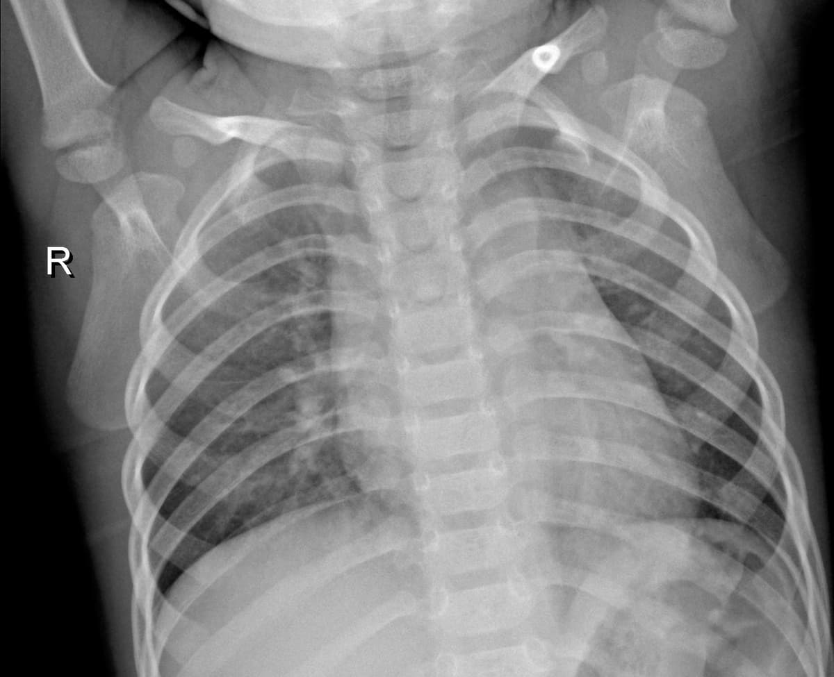Radiografia Normal — NIH Chest X-ray14