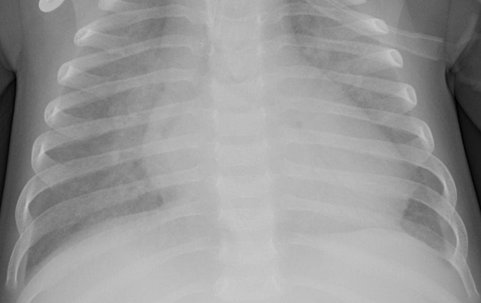 Pneumonia — NIH Chest X-ray14