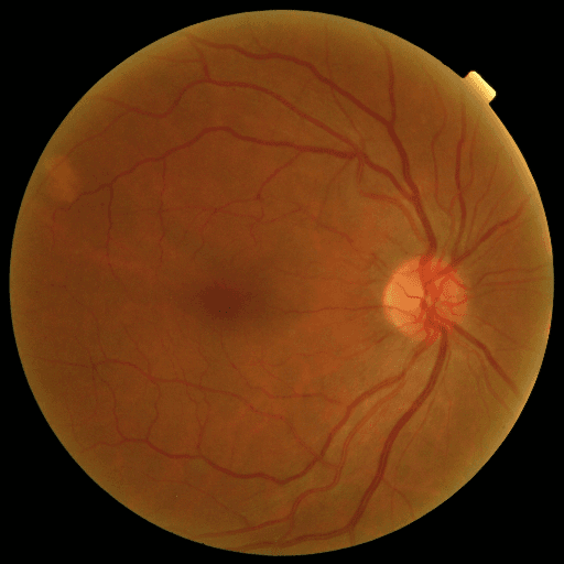 Proliferative DR — MESSIDOR-2