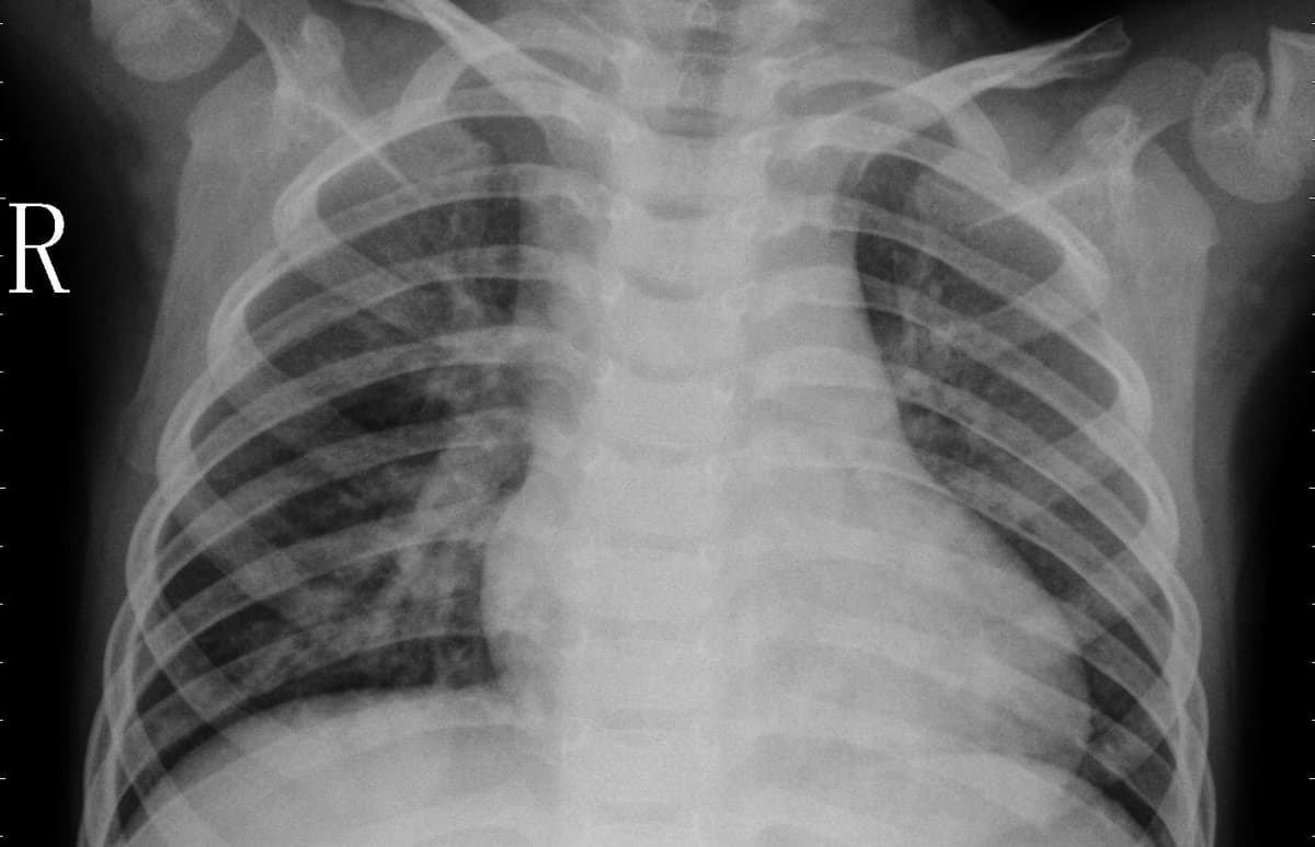 Pneumonia — NIH Chest X-ray14