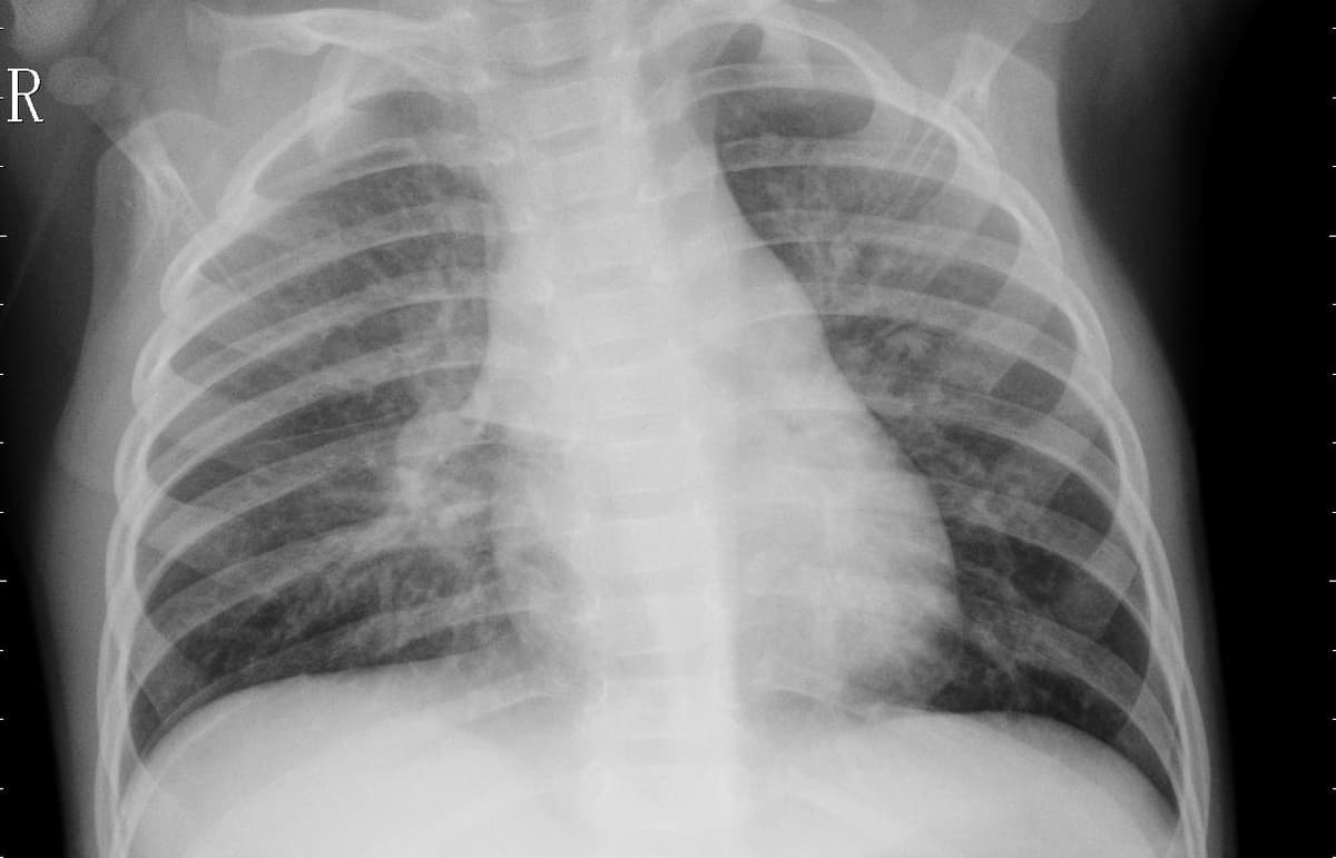 Pneumonia — NIH Chest X-ray14