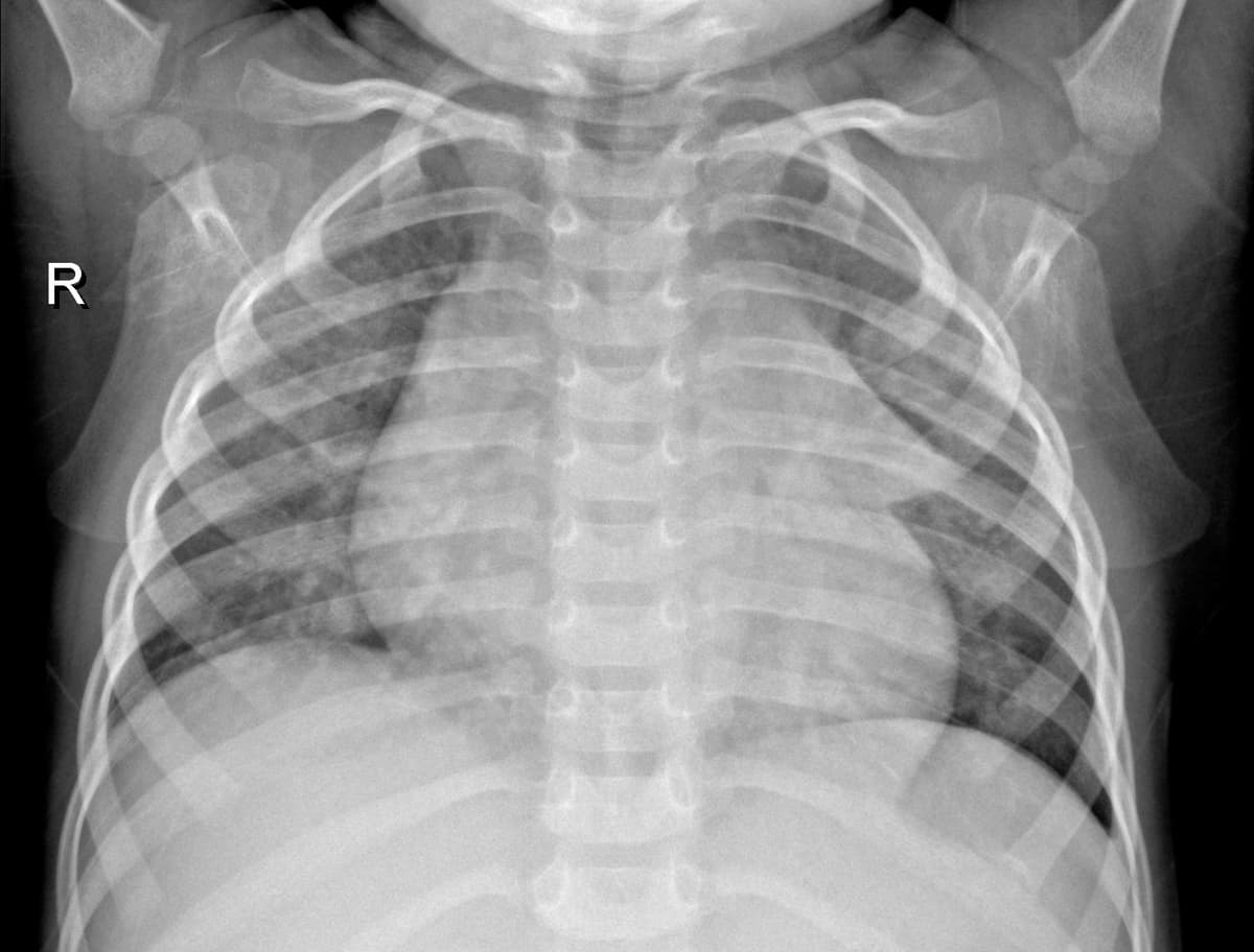 Radiografia Normal — NIH Chest X-ray14