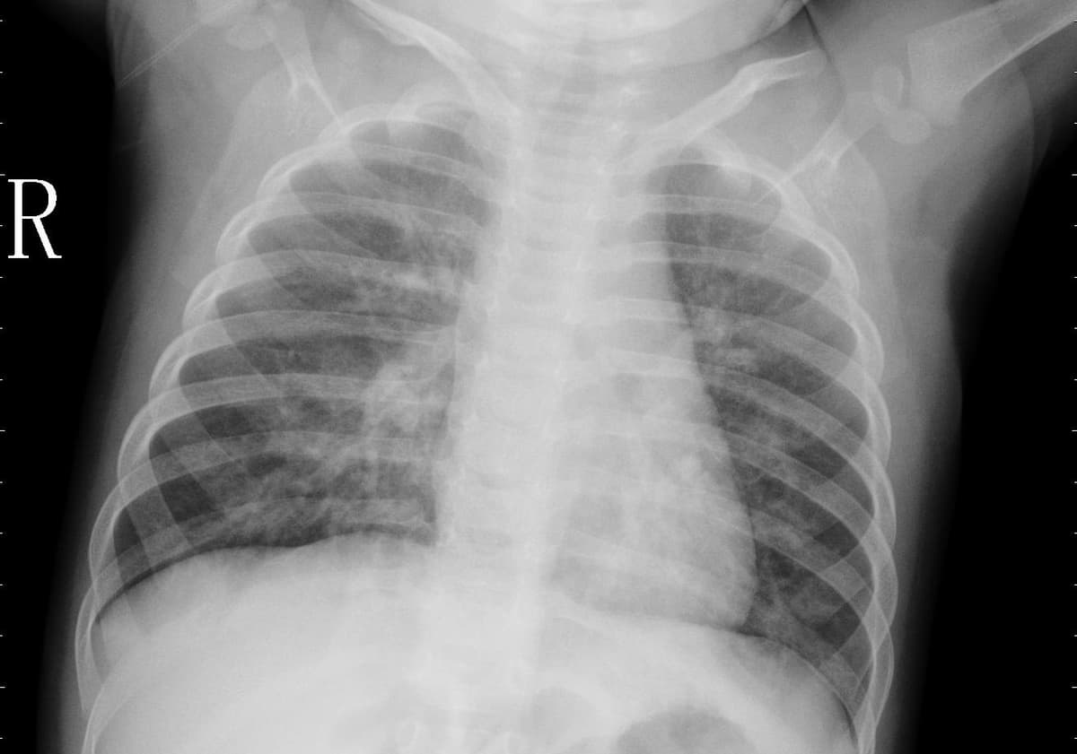 Pneumonia — NIH Chest X-ray14