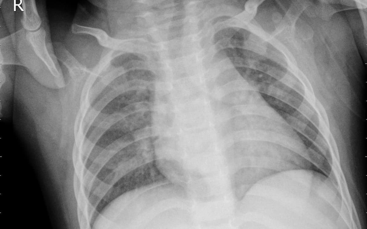 Pneumonia — NIH Chest X-ray14