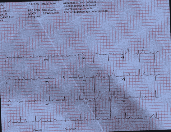 Normal ECG — PTB-XL