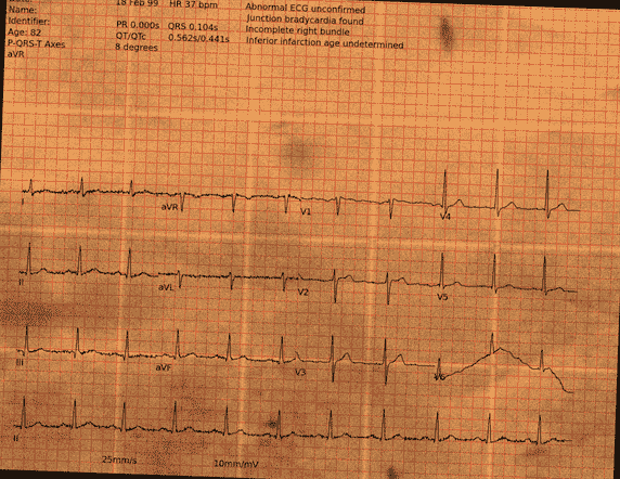 Normal ECG — PTB-XL