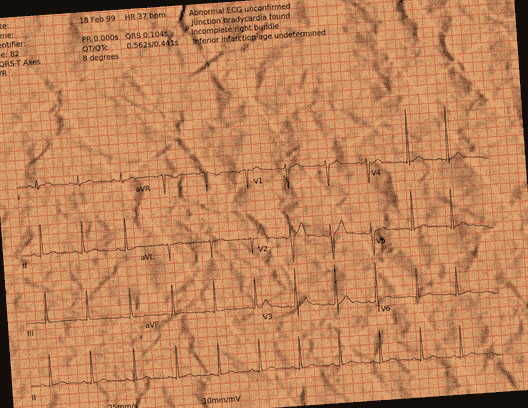 Normal ECG — PTB-XL