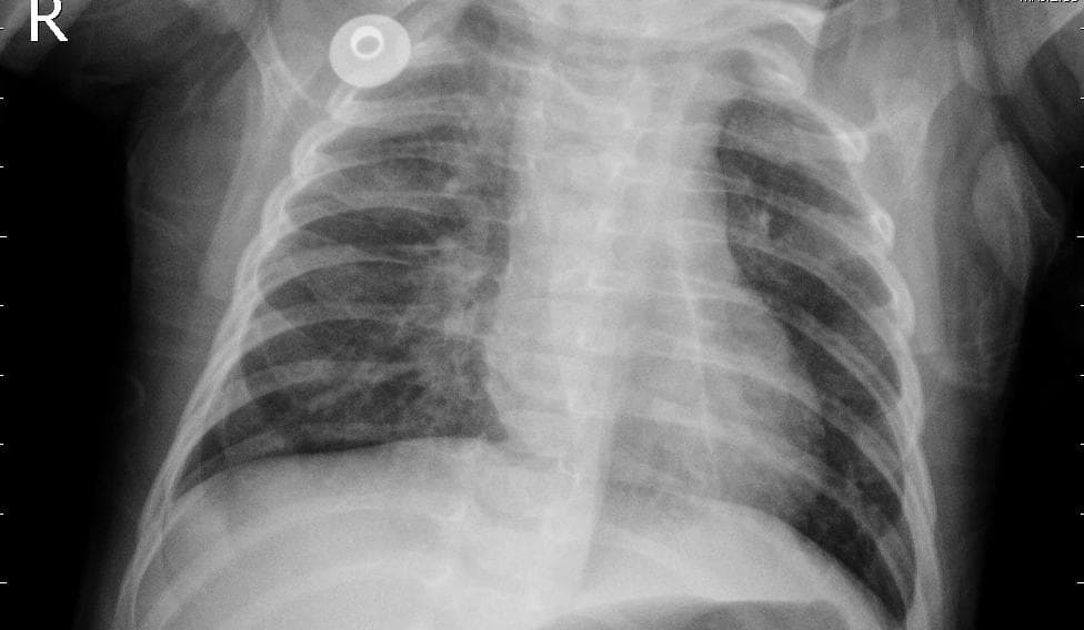 Pneumonia — NIH Chest X-ray14