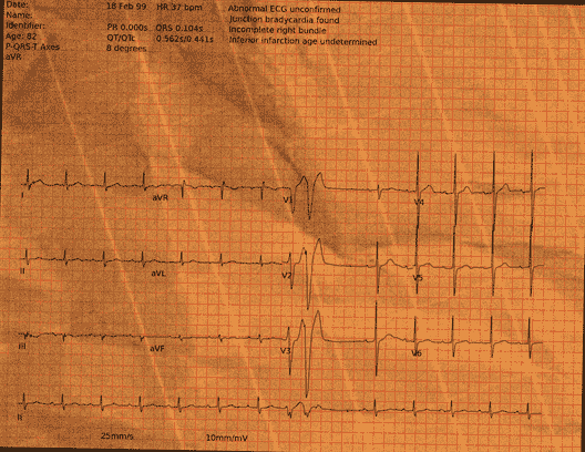 Normal ECG — PTB-XL