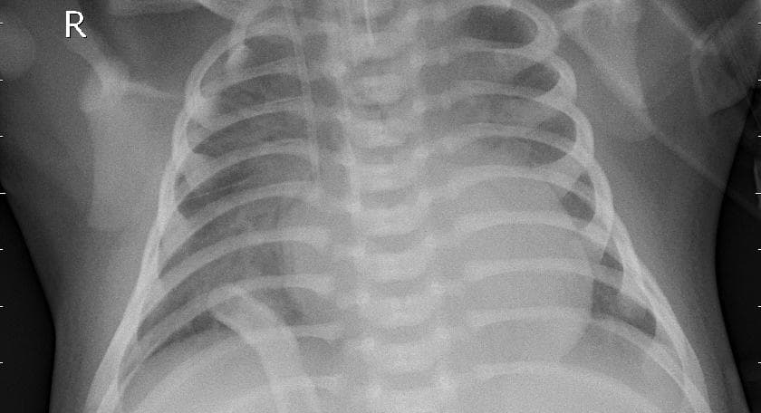 Pneumonia — NIH Chest X-ray14