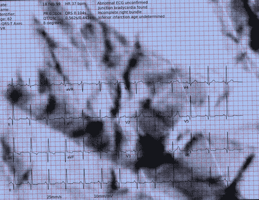 Normal ECG — PTB-XL