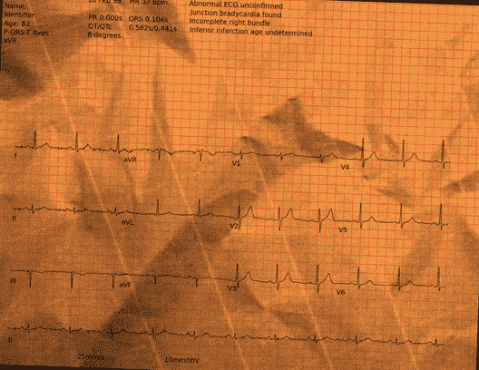 Normal ECG — PTB-XL