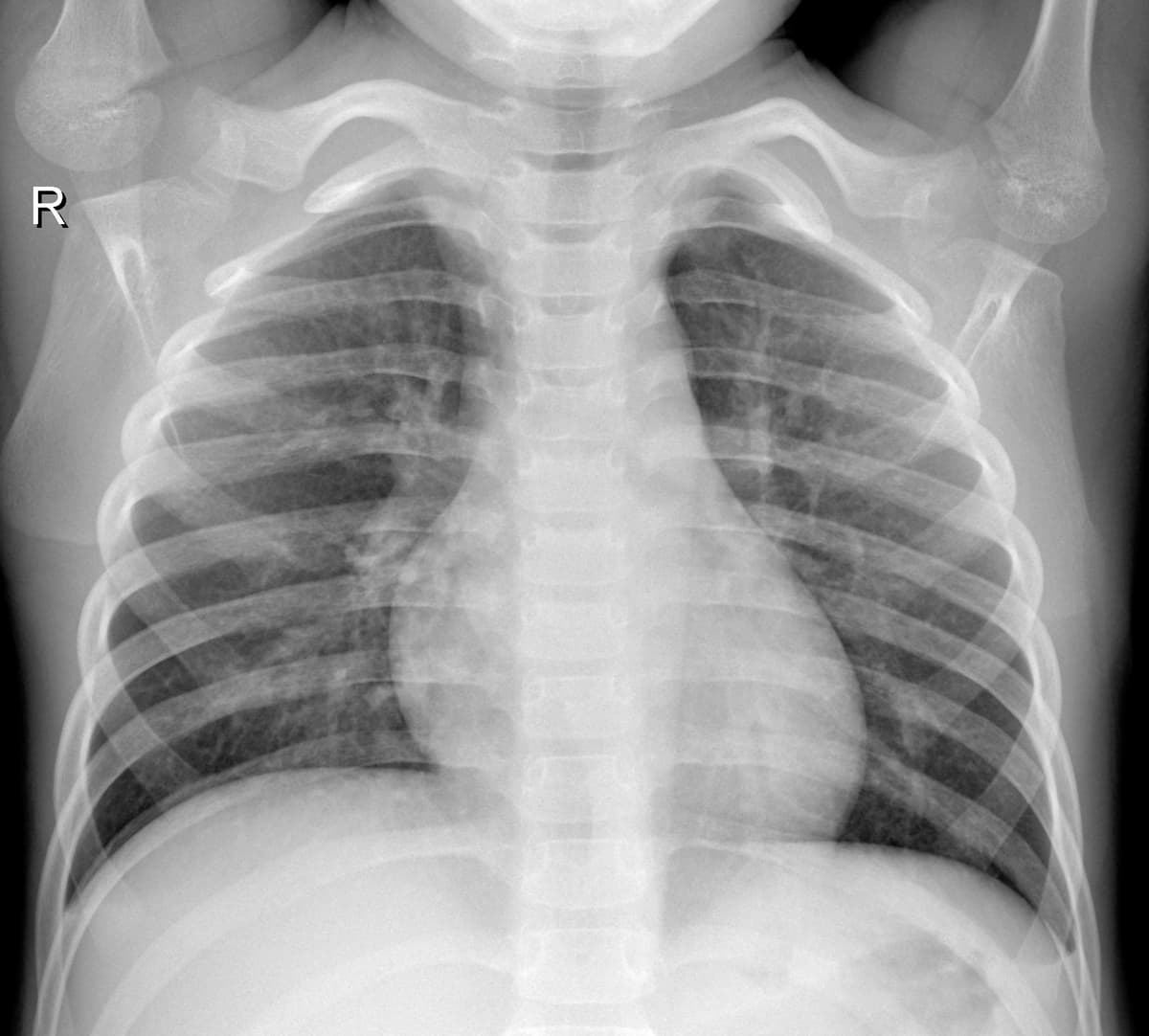 Radiografia Normal — NIH Chest X-ray14