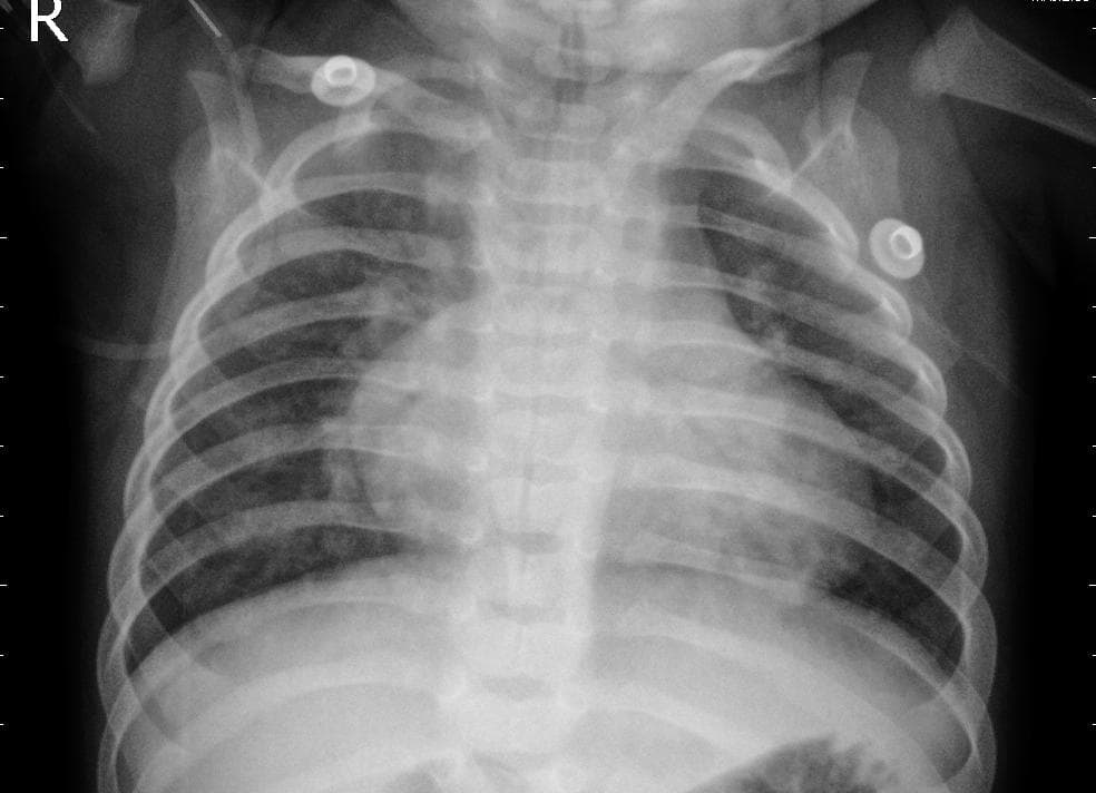 Pneumonia — NIH Chest X-ray14