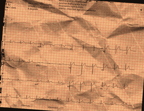 Normal ECG — PTB-XL