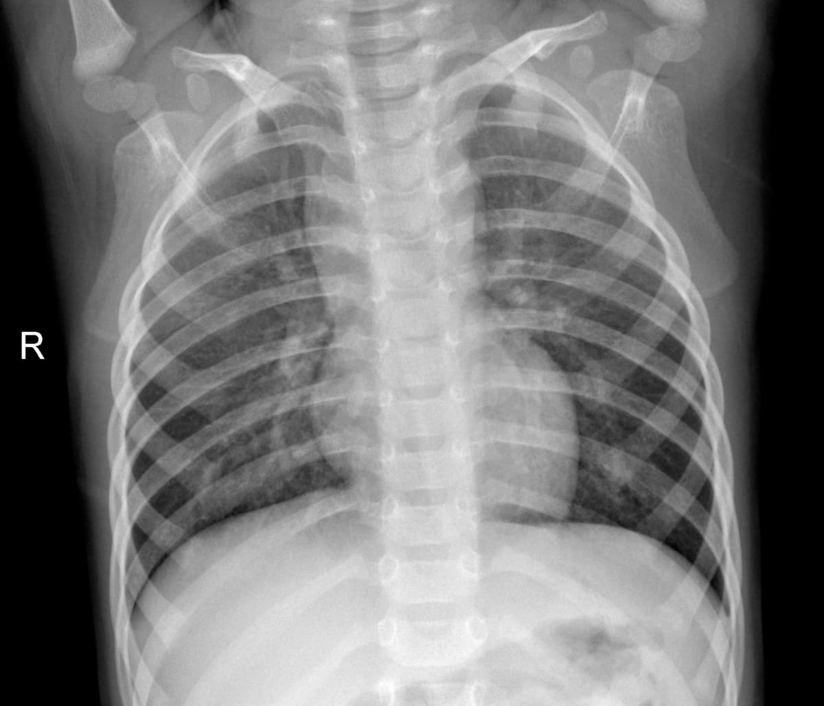 Radiografia Normal — NIH Chest X-ray14