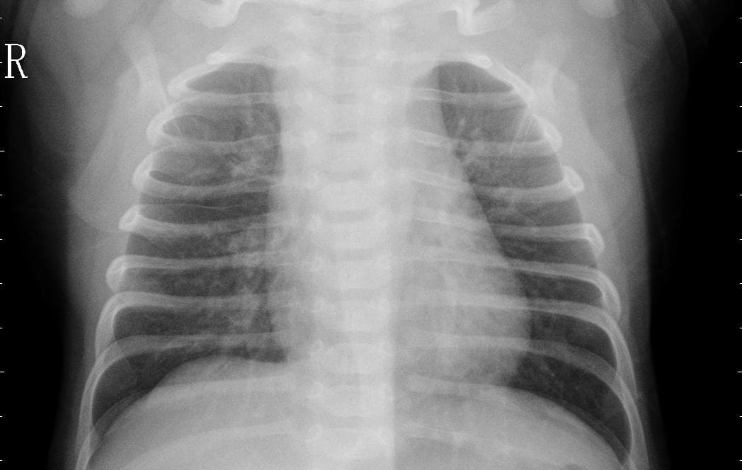 Pneumonia — NIH Chest X-ray14