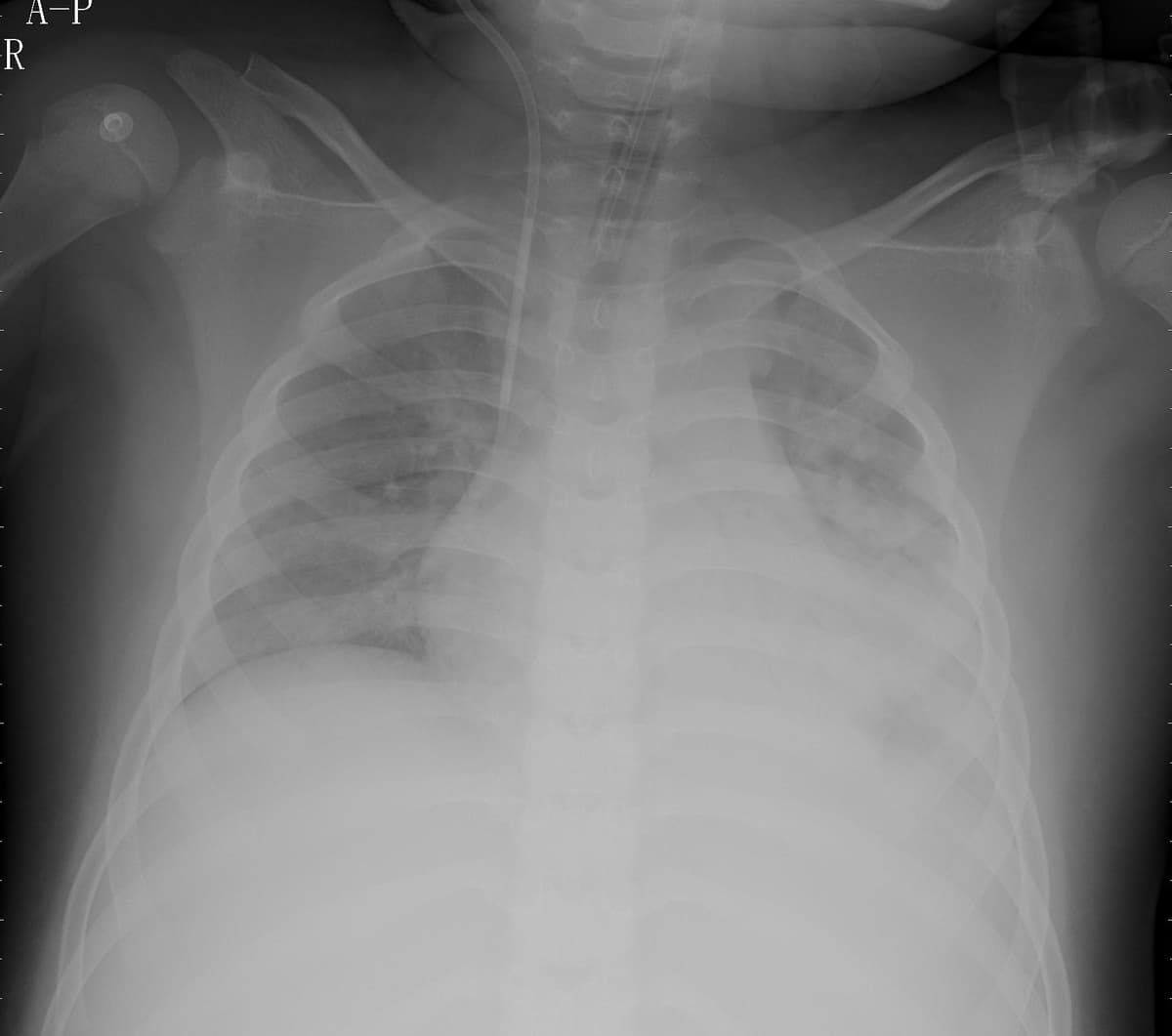Pneumonia — NIH Chest X-ray14