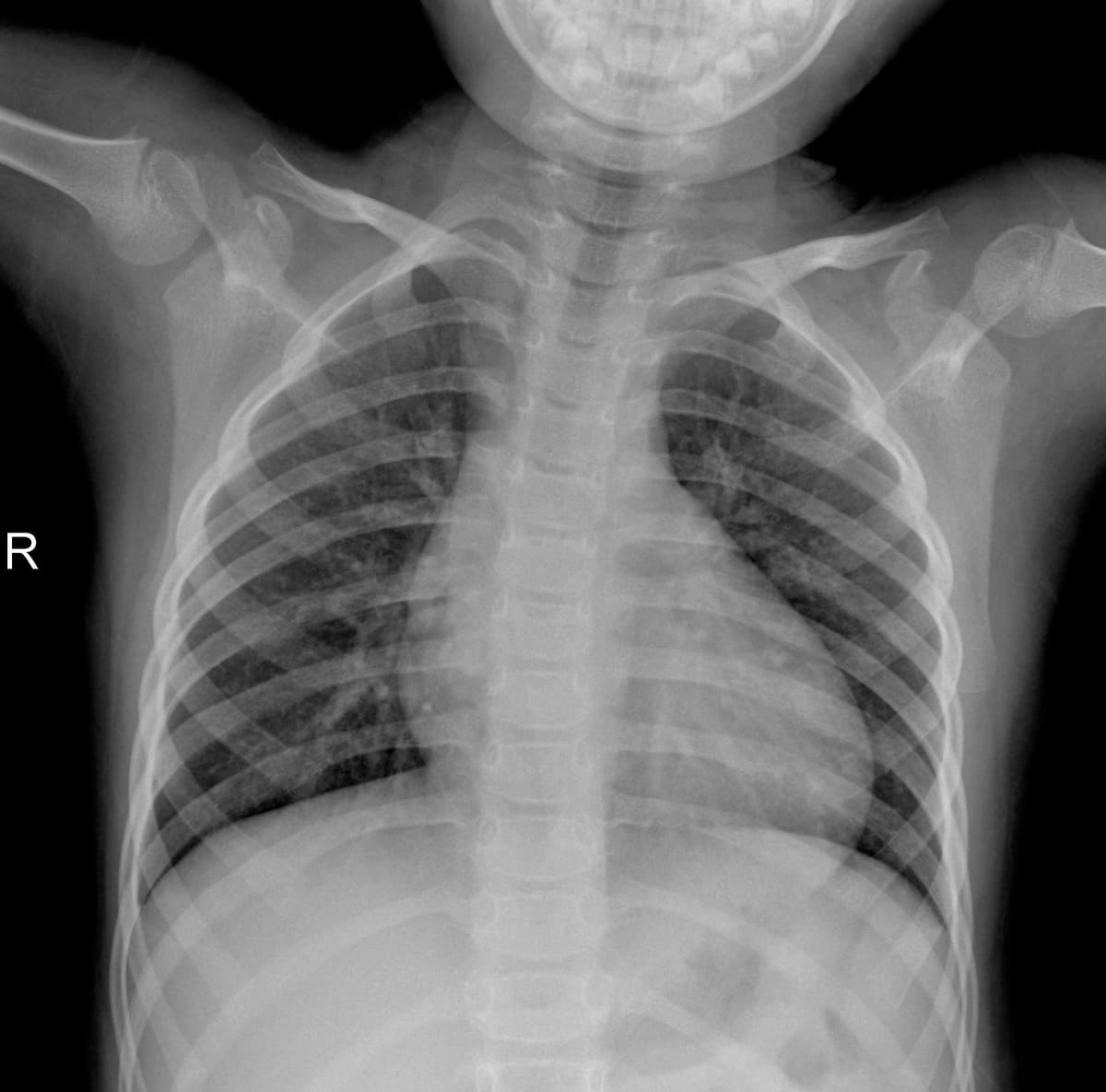 Radiografia Normal — NIH Chest X-ray14