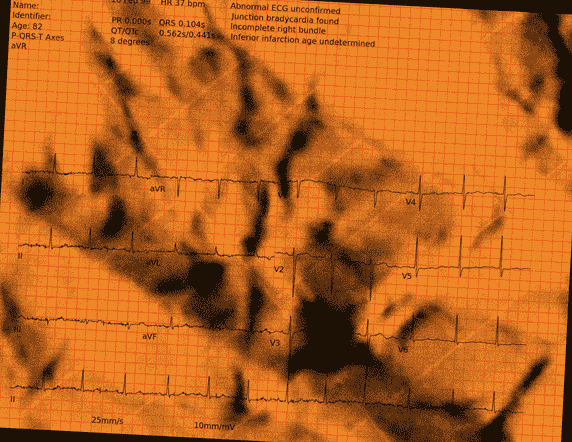 Normal ECG — PTB-XL