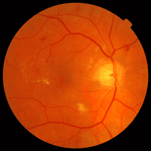 No Diabetic Retinopathy — MESSIDOR-2