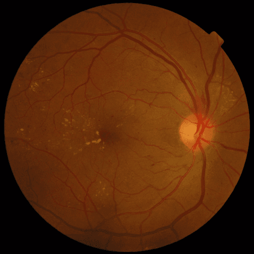 No Diabetic Retinopathy — MESSIDOR-2