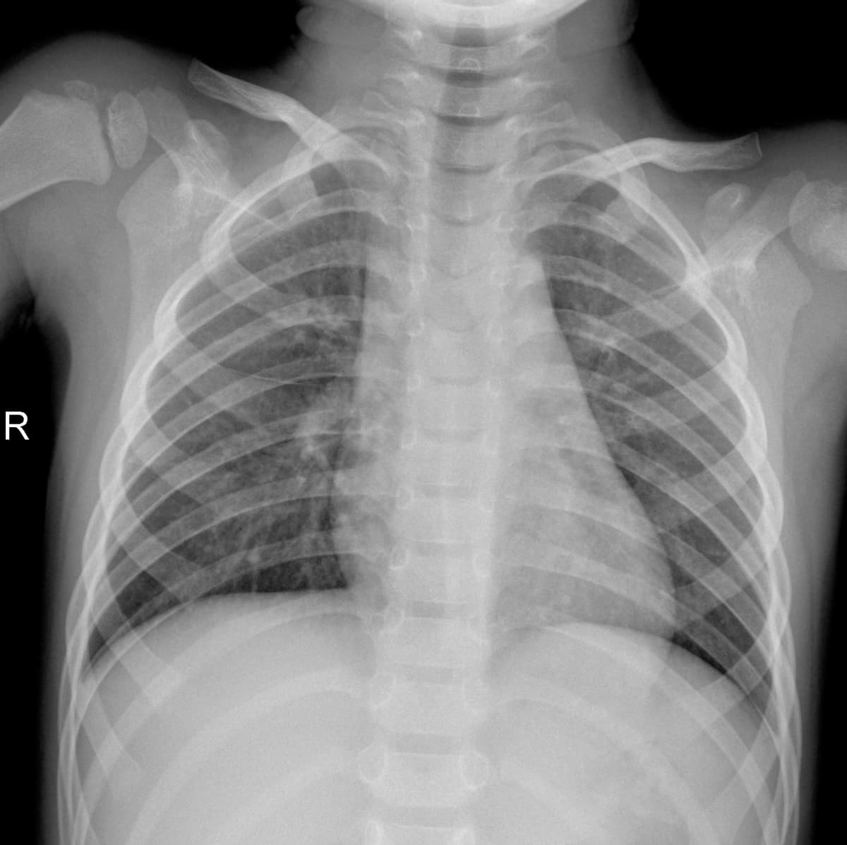 Radiografia Normal — NIH Chest X-ray14