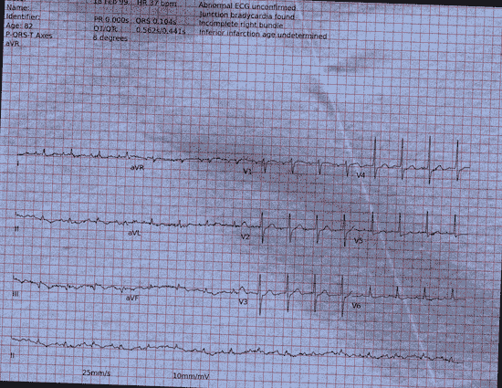 Normal ECG — PTB-XL