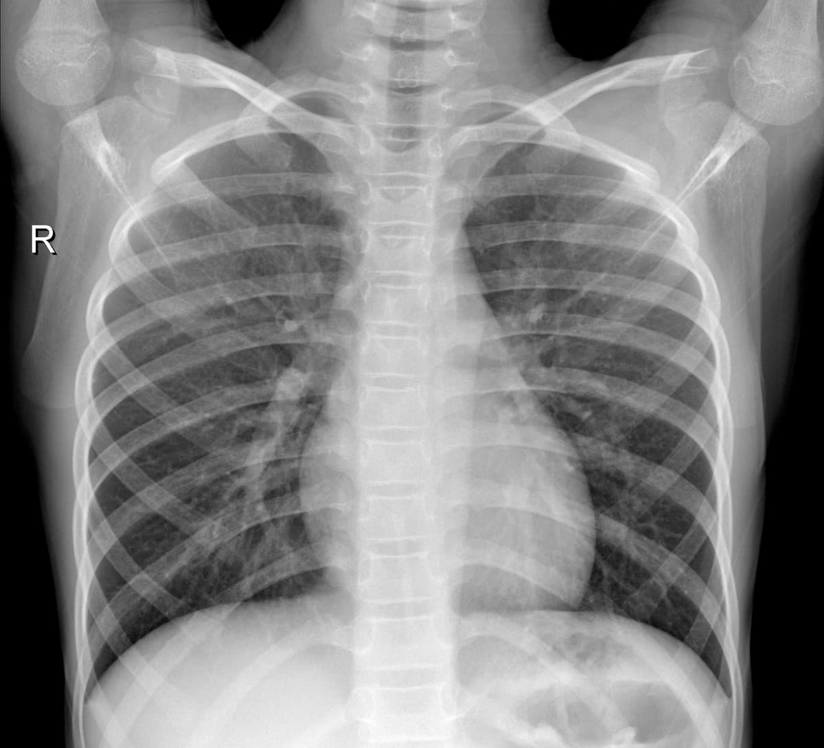 Radiografia Normal — NIH Chest X-ray14