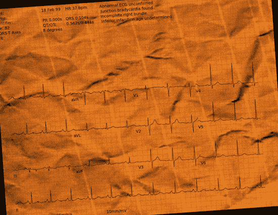 Normal ECG — PTB-XL