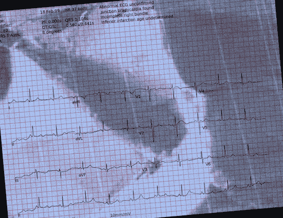 Normal ECG — PTB-XL