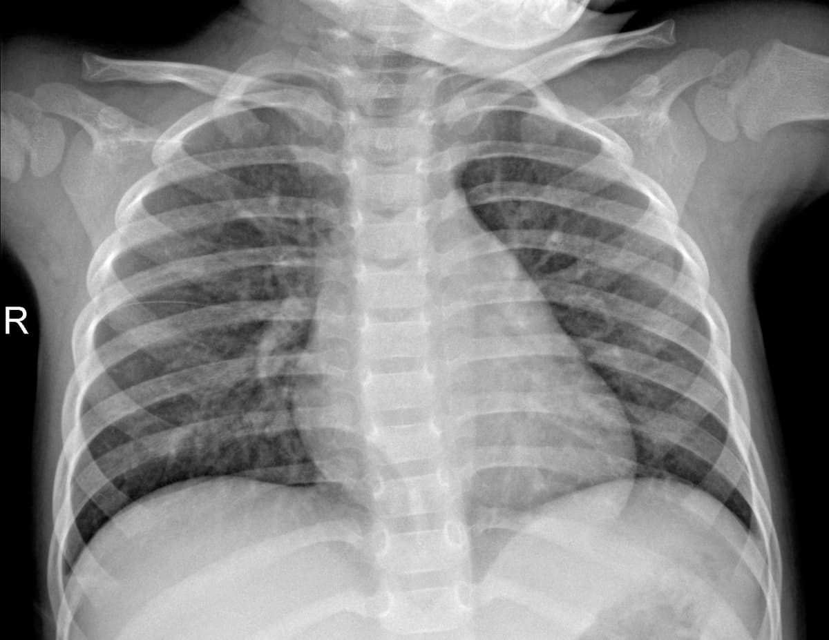 Radiografia Normal — NIH Chest X-ray14