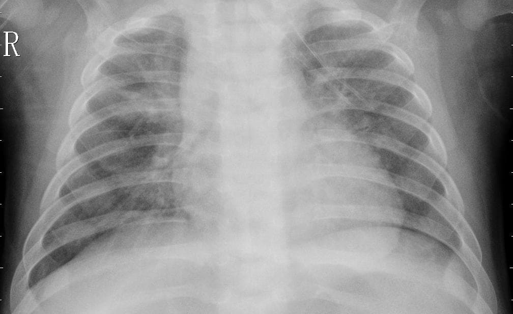 Pneumonia — NIH Chest X-ray14