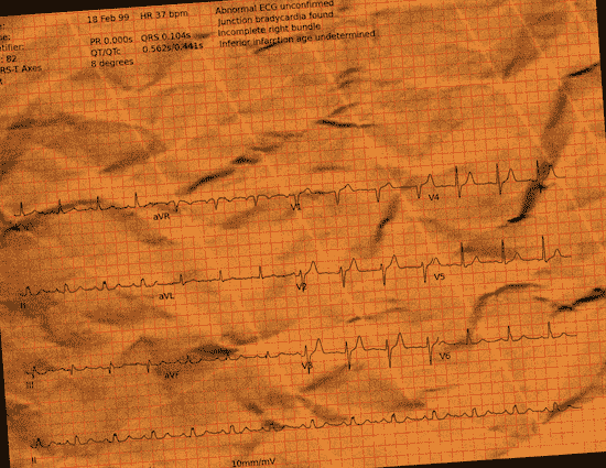 Normal ECG — PTB-XL
