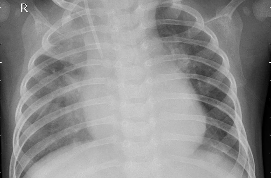Pneumonia — NIH Chest X-ray14