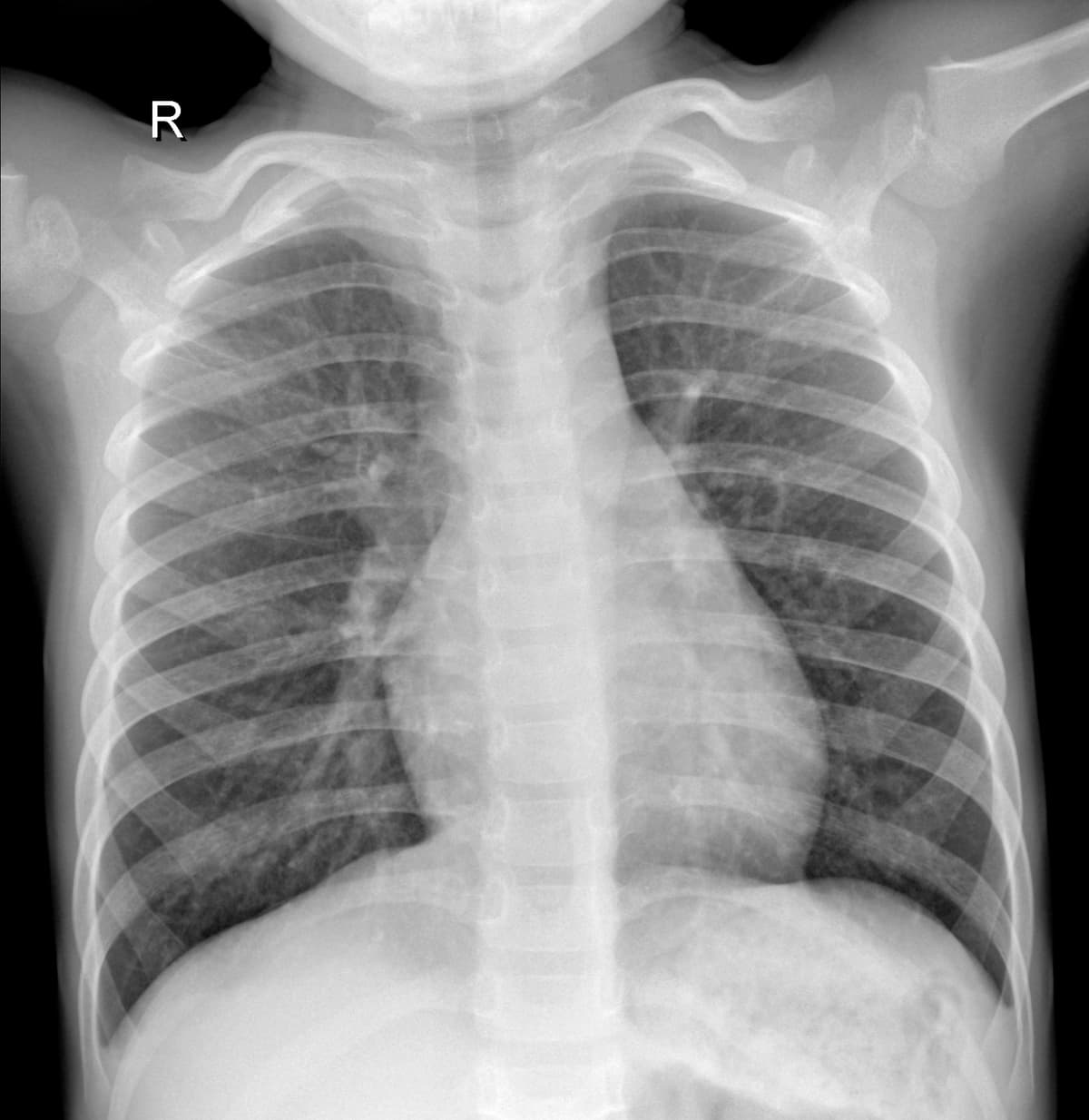 Radiografia Normal — NIH Chest X-ray14