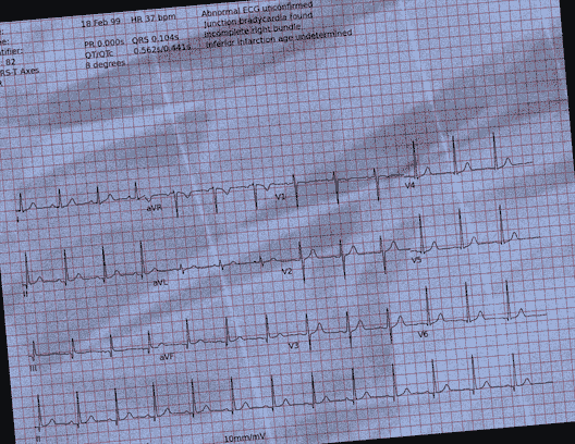 Normal ECG — PTB-XL