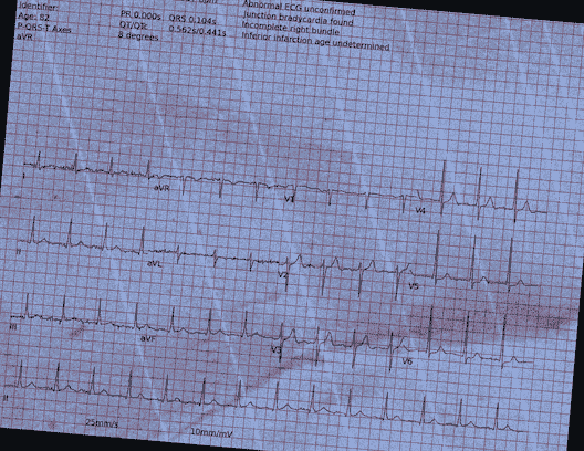 Normal ECG — PTB-XL