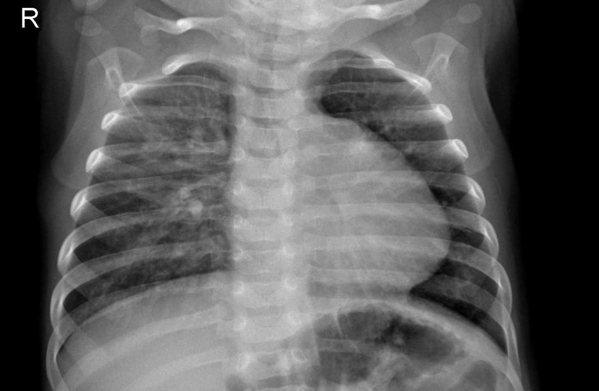Pneumonia — NIH Chest X-ray14