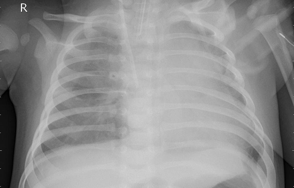 Pneumonia — NIH Chest X-ray14