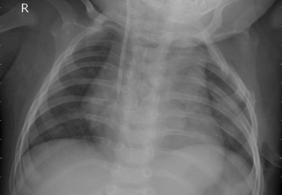 Pneumonia — NIH Chest X-ray14