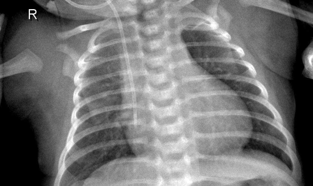 Pneumonia — NIH Chest X-ray14