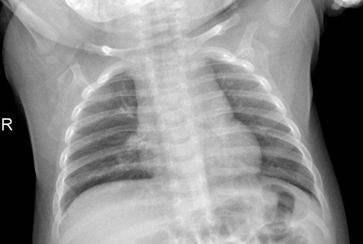 Radiografia Normal — NIH Chest X-ray14