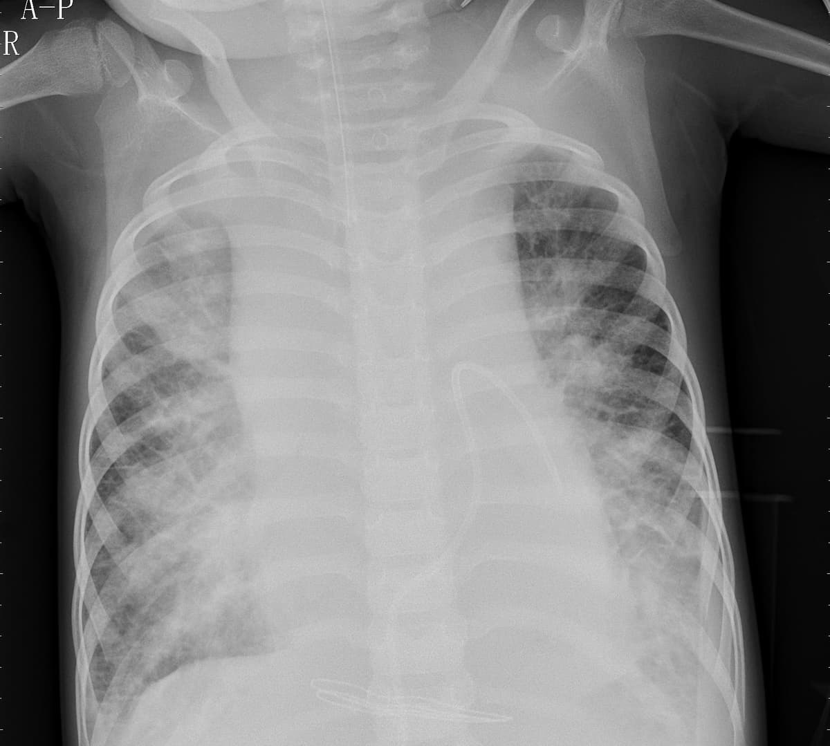 Pneumonia — NIH Chest X-ray14